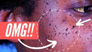 Why am I getting so many moles on my FACE Dermatosis Papulosa Nigra explained [upl. by Elcin]