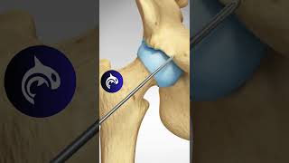 See how a Pincer Impingement of the Hip is repaired  3D Animation [upl. by Baptista352]