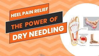 Heel Pain Releif  The power of Dry Needling SAROPHYSIO [upl. by Drusus384]