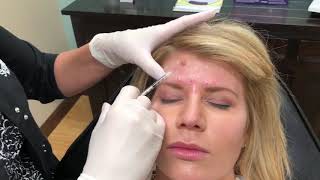 Allergan  Botox Injections [upl. by Irallih]