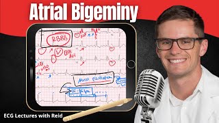 Atrial Bigeminy EKG  ECG Lecture [upl. by Webber208]