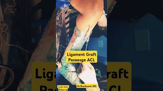 ACL Graft Passage Process लिगामेंट चढ़ाना 🔥aclinjury ligamenttear ligamentinjury kneeligament [upl. by Meisel407]