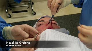 Tip Grafting in Rhinoplasty by Using the Endonasal or Closed Approach [upl. by Hirsh109]