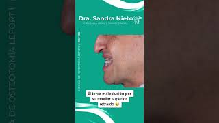 Cirugía Lefort 1 😎drasandranieto pacientes antesydespués maxilofacial greenscreen [upl. by Eillat]