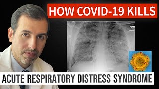 How Coronavirus Kills Acute Respiratory Distress Syndrome ARDS amp COVID 19 Treatment [upl. by Oenire377]