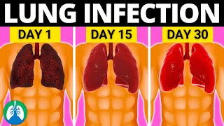 Top 10 Natural Lung Infection Treatments Home Remedies [upl. by Neztnaj]