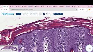 PITYRIASIS ROSEA Psoriasis clear cell acanthoma Lichen planus BLK LICHEN SCLEROSUS [upl. by Ainesell575]