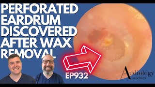 PERFORATED EARDRUM DISCOVERED AFTER EAR WAX REMOVAL  EP932 [upl. by Lona]