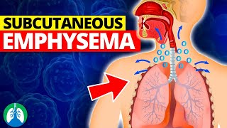 Subcutaneous Emphysema Medical Definition  Quick Explainer Video [upl. by Nysilla]