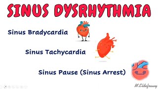 Sinus dysrhythmia  Tachycardia bradycardia and sinus pause [upl. by Toblat83]