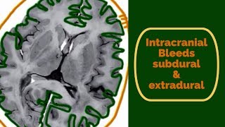 Intracranial bleeds Subdural and Extradural haematoma [upl. by Nigle]