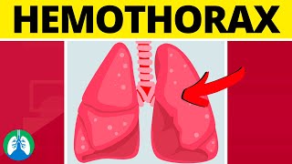 Hemothorax Medical Definition  Quick Explainer Video [upl. by Davida]