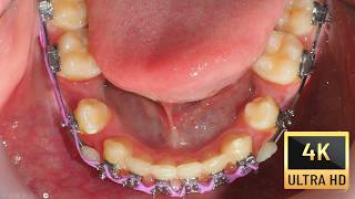 Implant site development  The Magic of Orthodontics trailer [upl. by Ardaid]