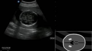 How To Pregnancy BPD HC AC and FL Measurements 3D Video [upl. by Galateah438]