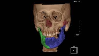 OSTEOMIELITIS MANDIBULAR ANTESDESPUÉS [upl. by Keldah]