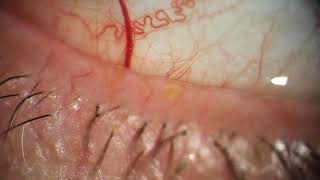 Popping Meibomian Eyelid Cyst Cap [upl. by Yv]