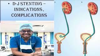 DJ STENTING  UNEDITED STEP BY STEP PROCEDURE INDICATIONS amp COMPLICATIONS [upl. by Childers]