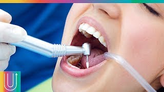 Así los dentistas tapan las caries en los dientes [upl. by Stonwin]