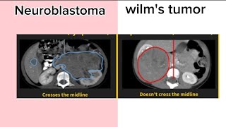 neuroblastoma Vs wilms tumor [upl. by France]