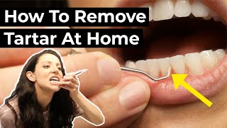 Is it Possible To Remove Tartar At Home [upl. by Yeldoow36]