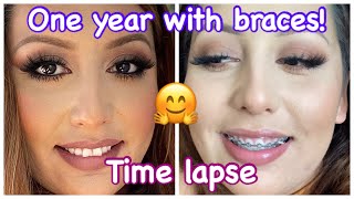 ONE YEAR WITH BRACES  Time Lapse  Correcting OverjetOverbite  Damon Braces [upl. by Jeremy67]