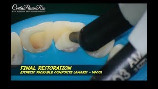 rewalling pre endodontic and post endodontic restoration composite resin anterior tooth amaris [upl. by Ycak]