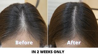 Simple home remedies to prevent hair loss and regrow hair naturally in 2 weeks I Stop hair fall 2021 [upl. by Merrill874]