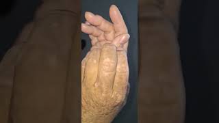 Scratching my skin off  eczema satisfying [upl. by Assyla130]