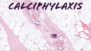 Calciphylaxis deadly complication of chronic kidney disease renal failure pathology dermpath [upl. by Atekin]