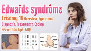 Edwards syndrome trisomy 18 causes symptoms diagnosis treatment screening prevention FAQ [upl. by Gearhart]