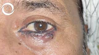 Ophthalmic Signs Eyelids [upl. by Airtemak]