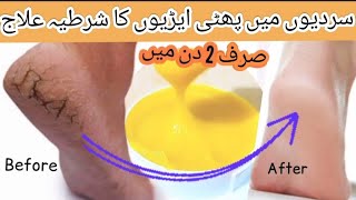 Remove Cracked Heels Remedy Get Beautiful Feet Permanently In 2 Days Homemade Dry Crack Heel Cream [upl. by Akenna58]