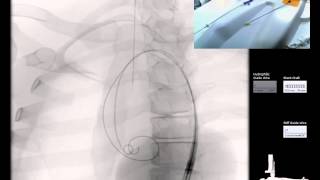 Mentice  Thoracic Endovascular Aortic Repair TEVAR Case Video [upl. by Alimrahs]