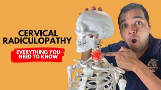 Cervical Radiculopathy Everything You Need To Know To Get Better Without Surgery [upl. by Aerbas604]