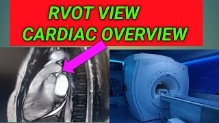 RVOT Cardiac mri Antomy RVOT Cardiac Cine Cardiac Mri [upl. by Latea]