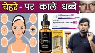 Melasma  चेहरे पर काले धब्बे  Medicine  Treatment  Doctor  Pharmacy  Nursing  MBBS  BHMS [upl. by Anerak]