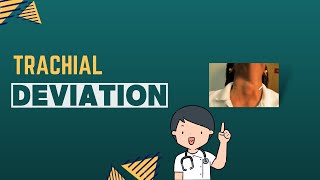 Tracheal Deviation clinical Examination [upl. by Laryssa]