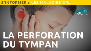 Perforation du tympan  Information patient [upl. by Silva]