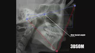 3DSOM ORTHODONTIC Non extraction case of Bimaxillary protrusion [upl. by Riobard601]