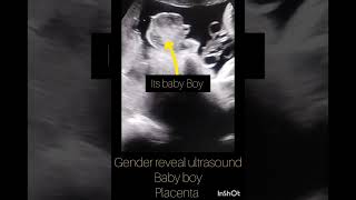 Ultrasound showing BabyBoy Pregnancy ultrasound Placenta position ultrasoundyoutubeshortsindia [upl. by Elliot]