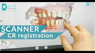 CR centric relation registration using dental intraoral scanner Primescan [upl. by Aruam313]