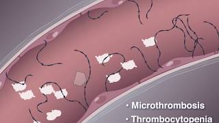 Improving Outcomes in TTP [upl. by Lohner]