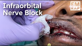 Infraorbital Nerve Block [upl. by Enelyaj]