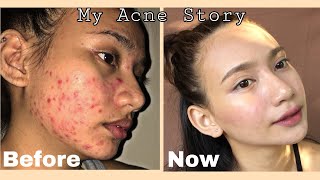 How I Cleared My Skin in 2 Months Using Affordable Products  Pictures  Philippines [upl. by Teuton406]