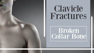 Fractures of the clavicle collarbone fractures [upl. by Kama]