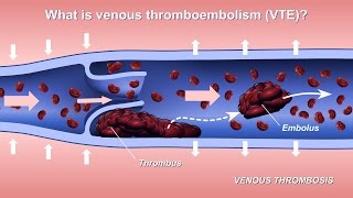 Understanding and Diagnosing Venous Thromboembolism VTE [upl. by Aniale]