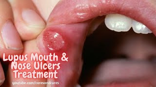 What Is Mouth Ulcer  Mouth Ulcer Symptoms  Mouth Ulcer Causes  What Is Lupus Disease [upl. by Lada]