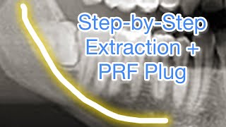 StepbyStep Horizontal Wisdom Tooth Removal with Nerve Exposure and PRF Plug [upl. by Rexanne]