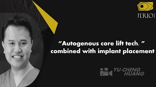 “Autogenous core lift tech ” combined with implant placement [upl. by Adnilasor]