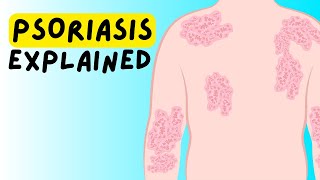 What is Psoriasis Definition Etiology Classification Pathophysiology Diagnosis Treatment [upl. by Jorge]